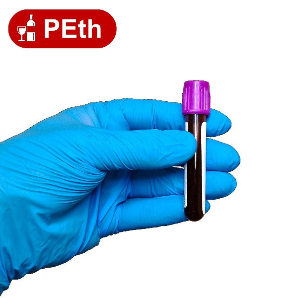 PEth Alcohol Test London | Alcohol Misuse